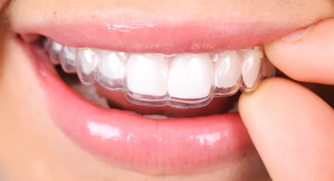 Retainer Too Tight