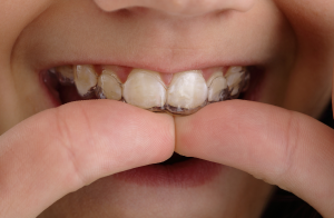 Retainer Too Tight: 5 Real Warning Signs, Safely Fixed