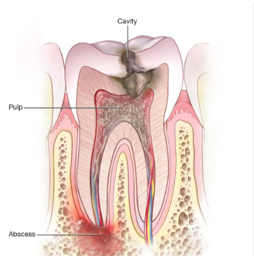 Tooth Infection