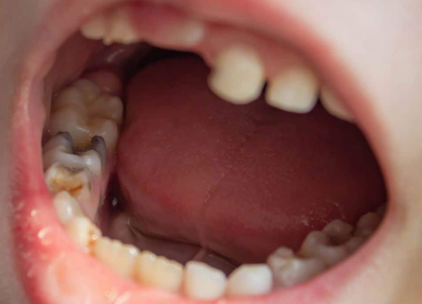 Tooth Infection
