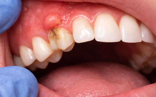 Tooth Infection