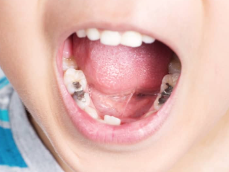 Preventing Cavities in Children
