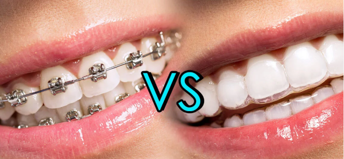 Invisible Aligners vs Braces