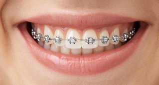 Invisible Aligners vs Braces