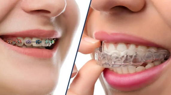 Invisible Aligners vs Braces
