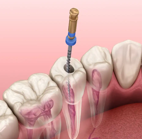 Root Canal Failing Years Later