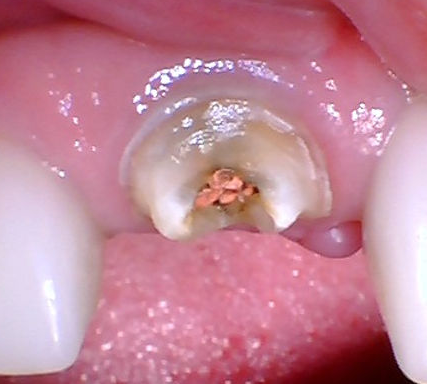 Root Canal Failing Years Later
