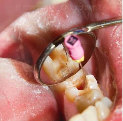 Root Canal Failing Years Later