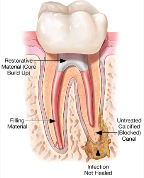 Root Canal Retreatment in Chinchwad