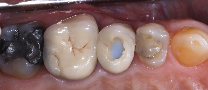 Root Canal Retreatment in Chinchwad
