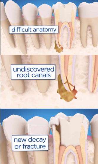 Root Canal Retreatment in Chinchwad