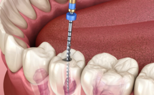 Root Canal Retreatment in Chinchwad: 7 Proven Steps to End Pain and Save a Tooth